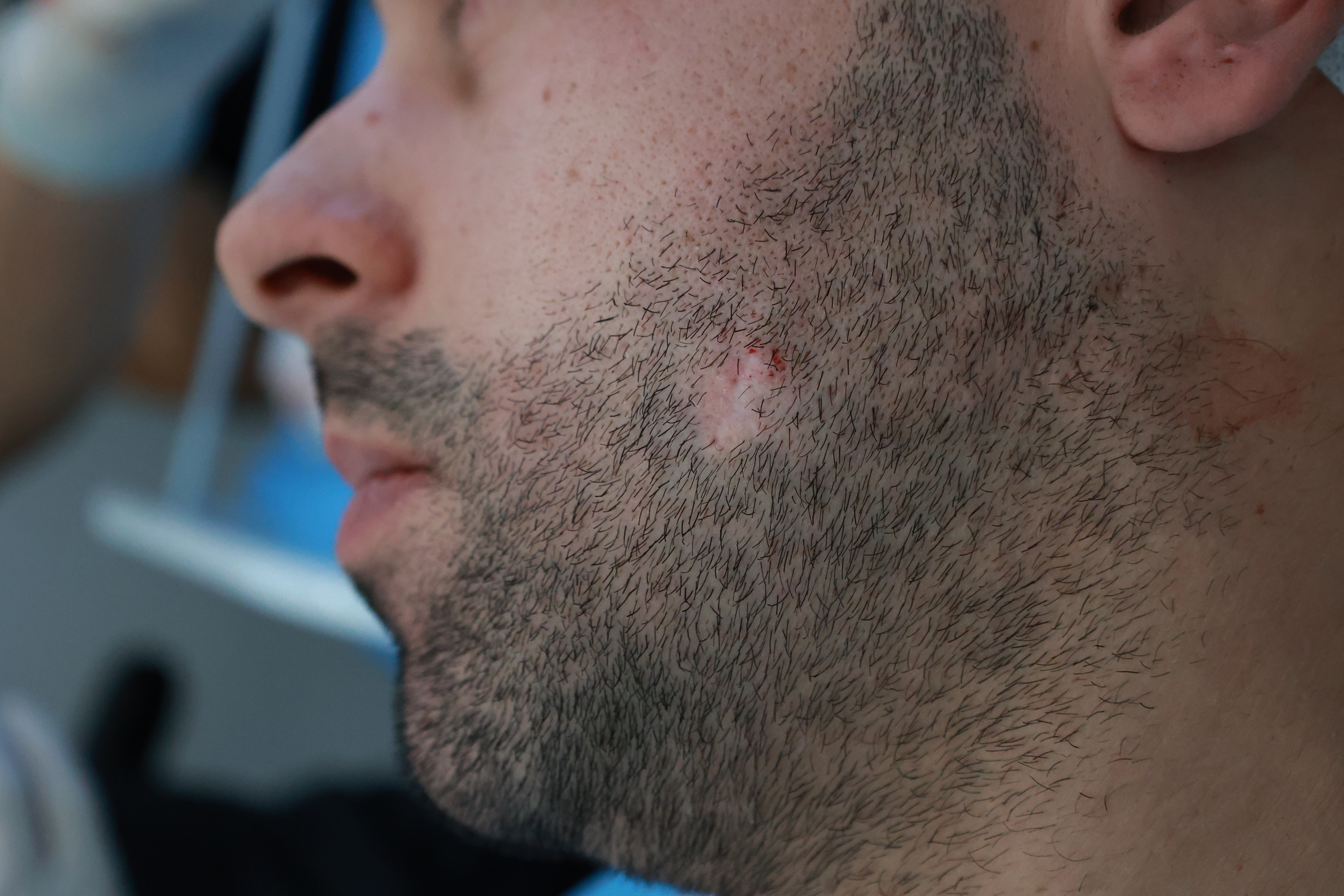 Kandidatët për transplantin e mjekrës